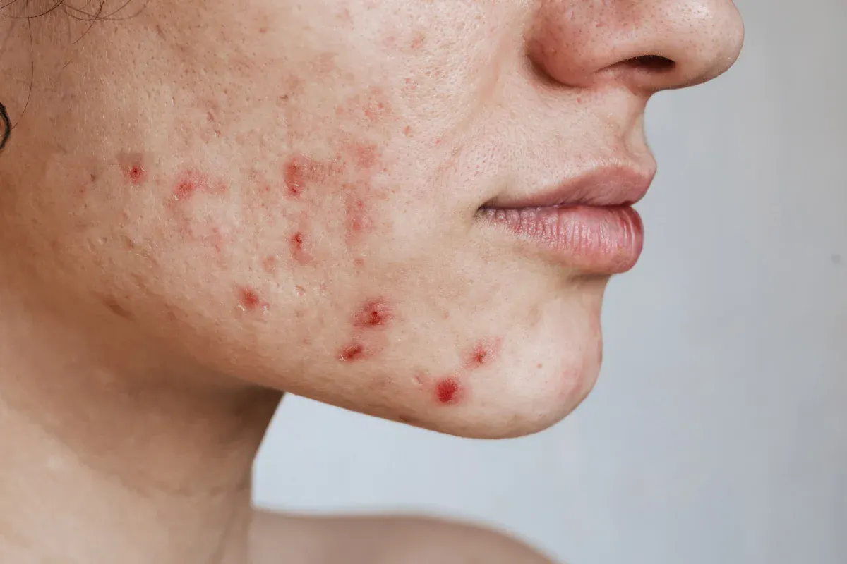 acne-treatment